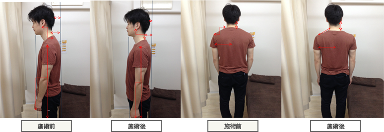 施術前、施術後の比較