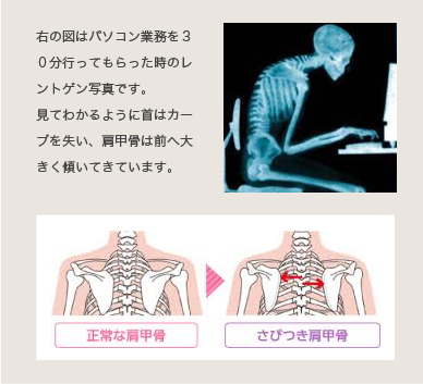 パソコン業務を３０分行ってもらった時のレントゲン写真です。見てわかるように首はカーブを失い、肩甲骨は前へ大きく傾いてきています。